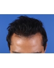 After Hair Transplant&nbsp;2 Sessions (Areas)